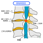 頚椎狭窄症（頸部脊柱管狭窄症）専門治療がある大阪の整体とカイロプラクティック